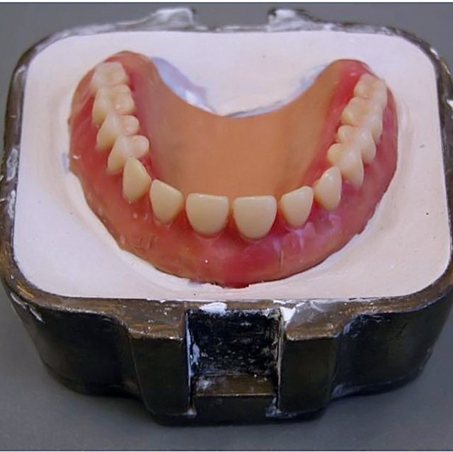snap in dentures